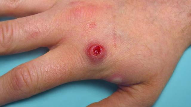 ¿Entendiendo la viruela del mono y cómo prevenirla?
