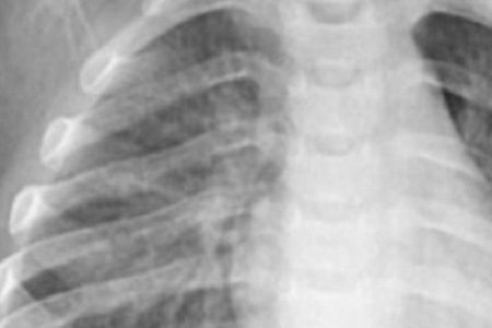 Detección rápida de Chlamydia pneumoniae: confiable y eficiente