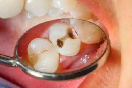 Babio lanza el medio de enriquecimiento de caries avanzado para la detección de caries con dientes tempranos